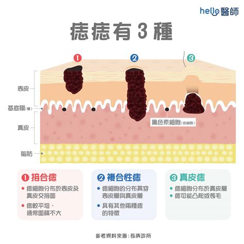 痣的種類|為什麼臉上的痣越來越多？皮膚科醫師解析長痣原因、。